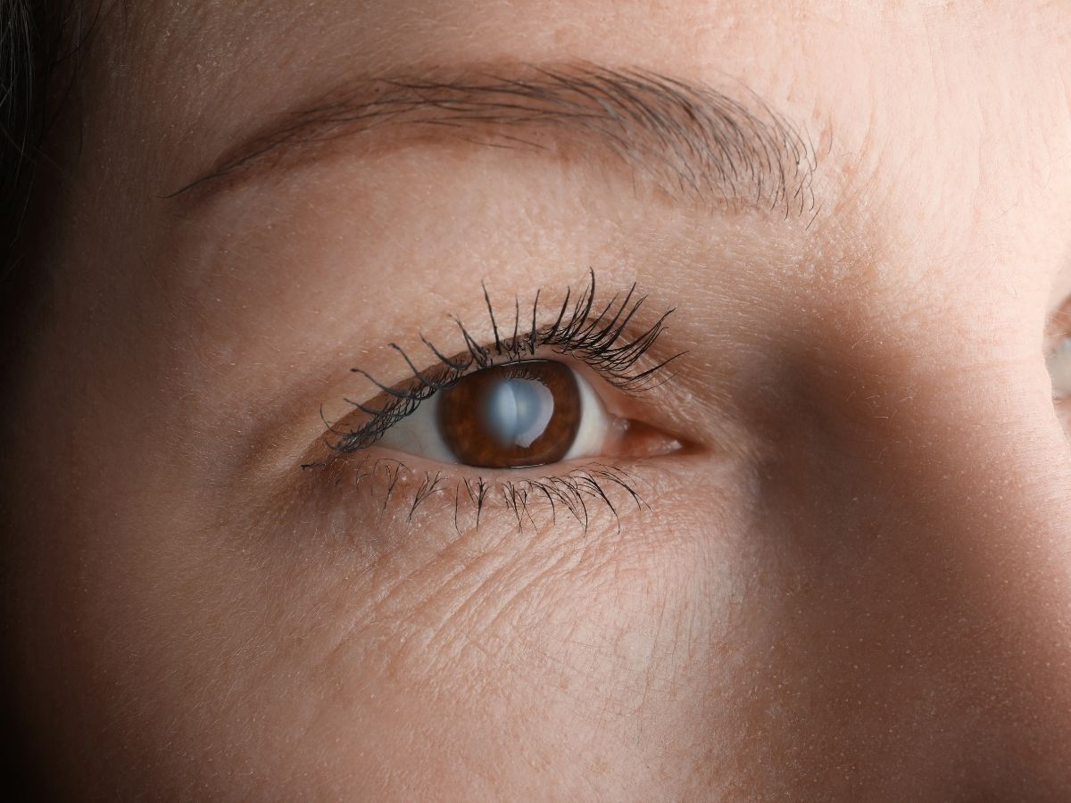 person with a cataract in their eye