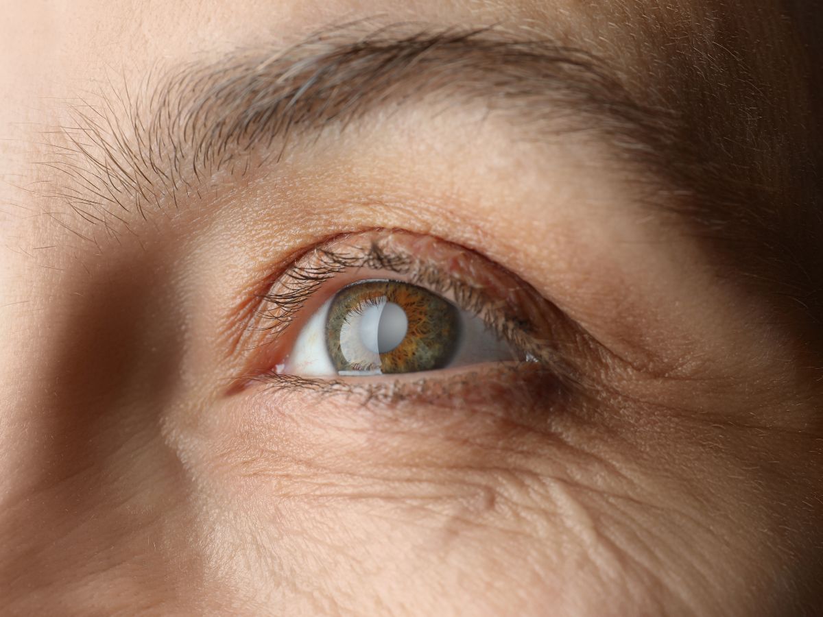 Close up of a person with cataracts