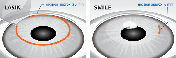 Side by Side comparison LASIK versus SMILE