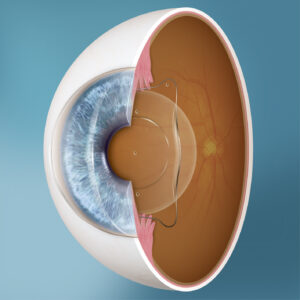 EVO ICL Procedure