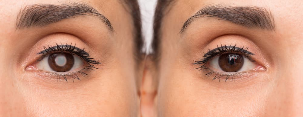 Side by side comparison of having cataracts and healthy eyes. The Cataract Surgeons.