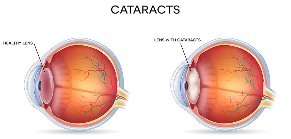 Cataracts Illustration