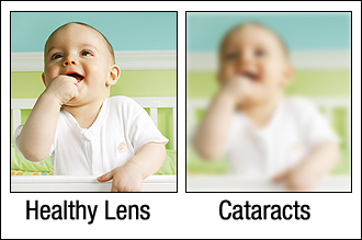 Healthy eye vs eye affected by Cataracts