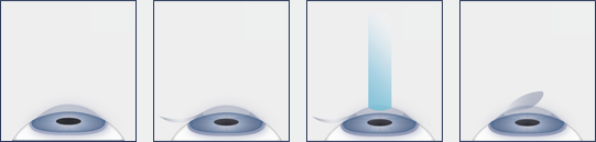 Chart Showing the LASIK Eye Surgery Procedure