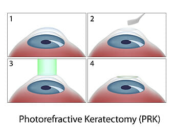 PRK Diagram Chart